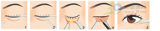 眼部整形　手术过程图解