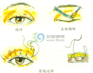 双眼皮切开法与小切口去脂埋线法