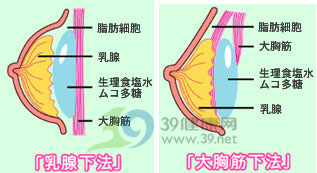 假体隆胸术手术概述