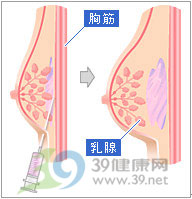 自体脂肪隆胸