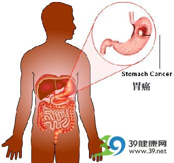 一个胃癌患者的抗癌日志