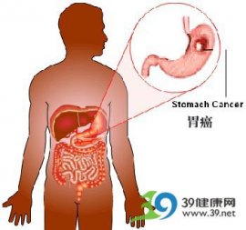 一个胃癌患者的抗癌日志