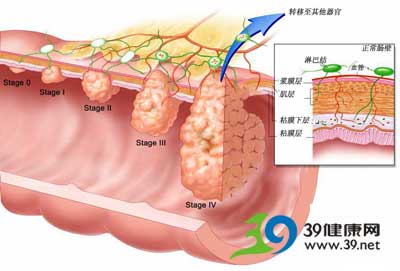 每天八千步 对抗结肠癌