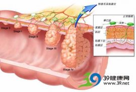 每天8000步 对抗结肠癌