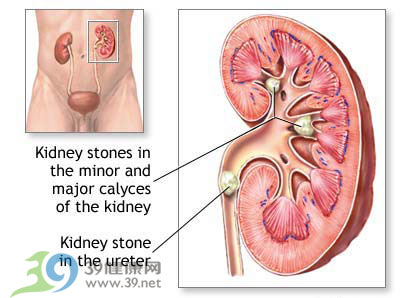 夏季喝水少 易患肾结石