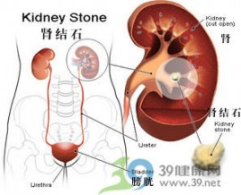 专家提醒：睡前一杯水尿路结石几率低一半