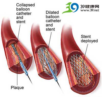 心肌梗死图文解释