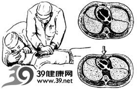 心脏病急救ABCDE