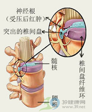 介绍微创治疗腰椎间盘突出