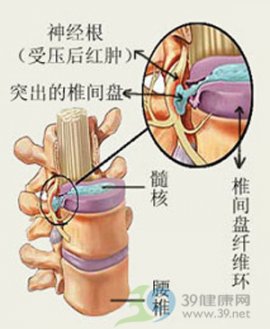 腰突的微创治疗知多少