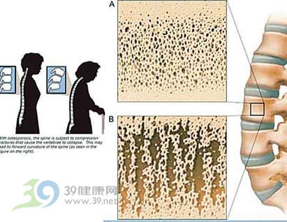 女性更年期 当心“骨松”