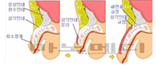 韩式阴茎延长增粗术